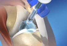 Протез синовиальной жидкости в лечении артроза